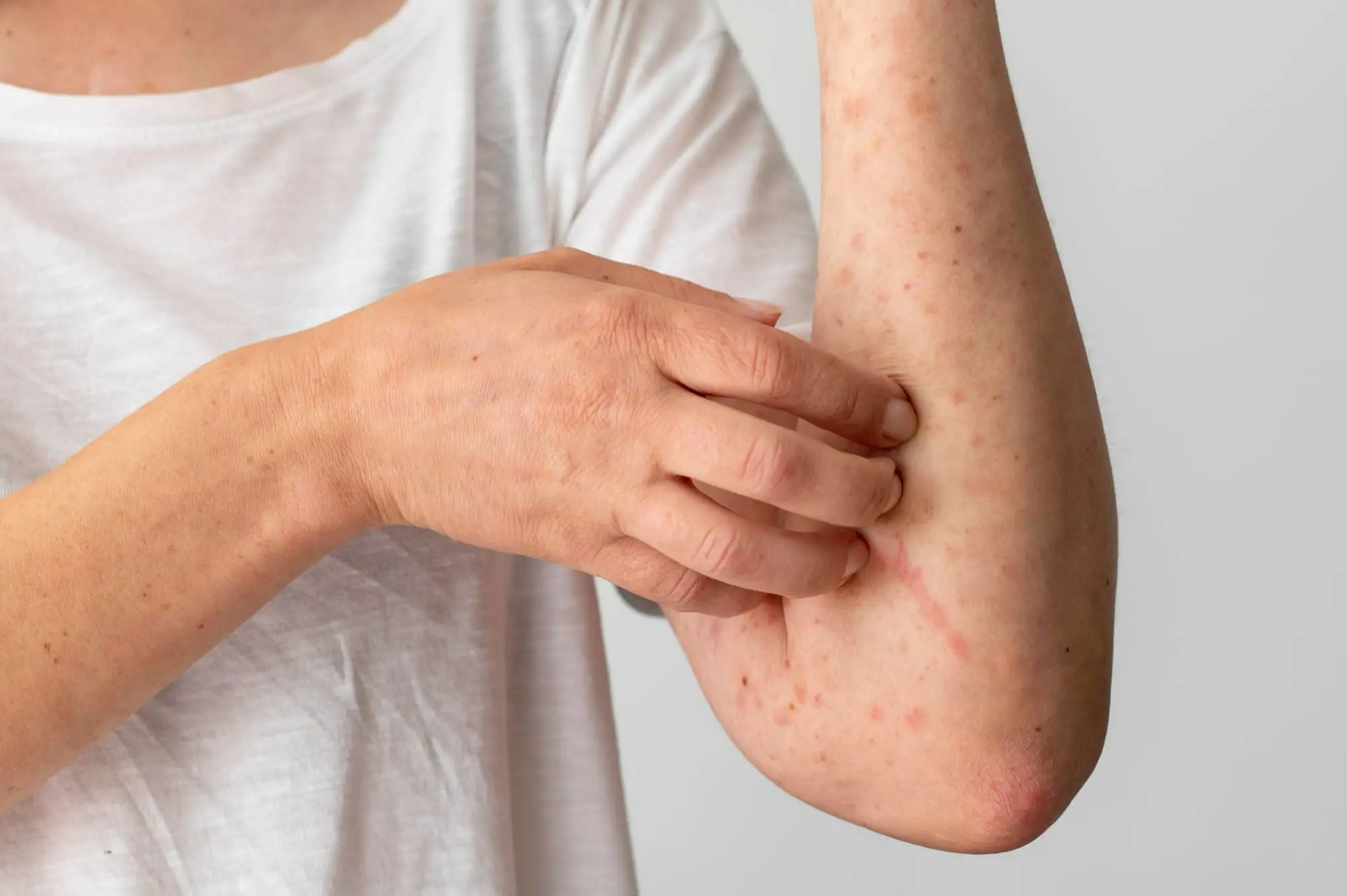 chronic-skin-disease